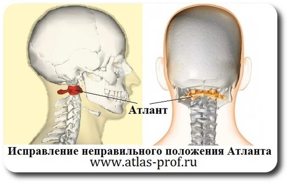 Позвонок Атлант вправление