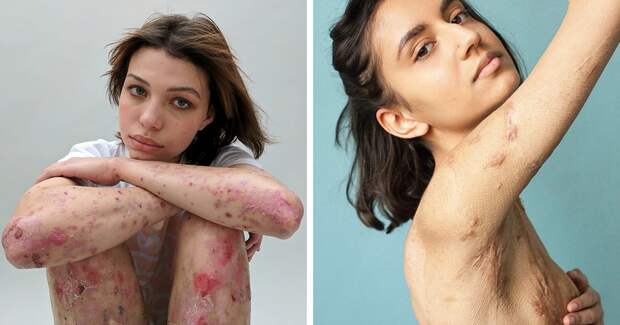 People Reveal Their Scars And How They Got Them In A Powerful Photo Project