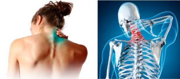 Сегодня ШЕЯ УБИВАЕТ втрое больше людей чем онкология