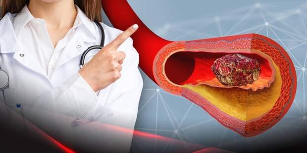 Врач Соколова: при нормальной коагулограмме может сохраняться риск тромбоза