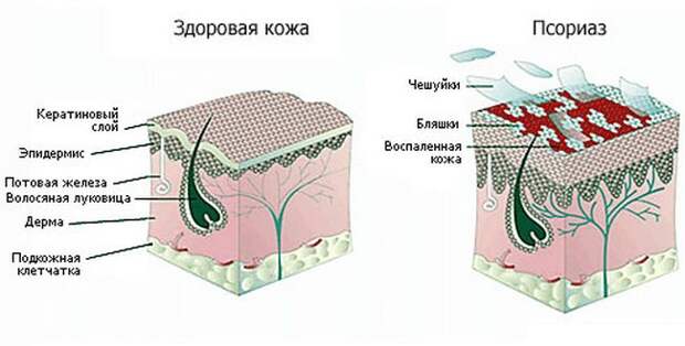 Народные рецепты при псориазе