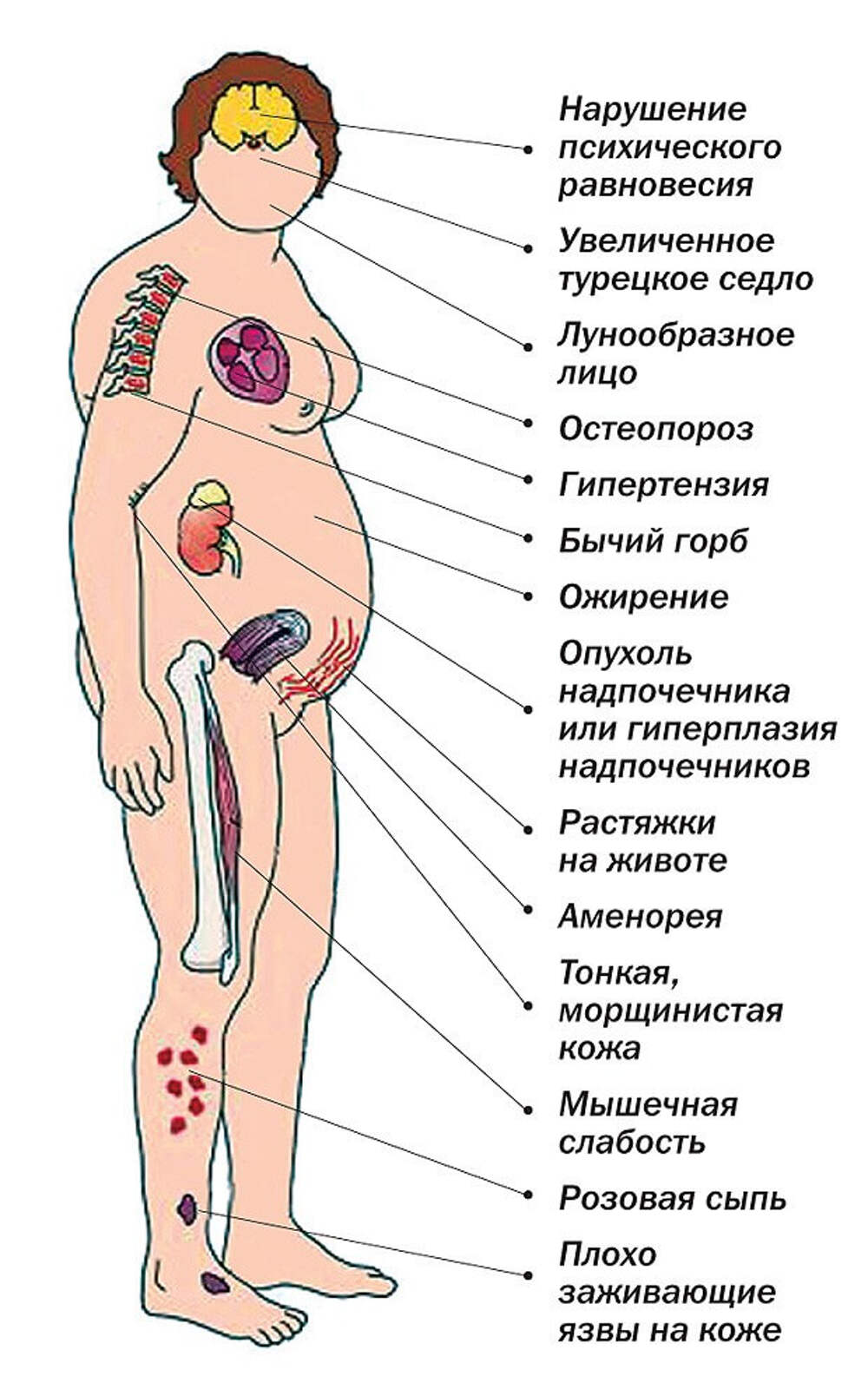 Иценко Кушинга Болезнь Фото