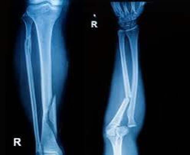Ударно-волновая терапия как метод ускорения консолидации переломов