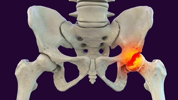 Ударно-волновая терапия (УВТ) при лечении асептического некроза тазобедренного сустава