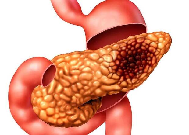 Поджелудочная железа расположена позади желудка, в задней части живота, рядом с желчным пузырем. Она содержит железы, вырабатывающие гормоны, в том числе инсулин, и ферменты.