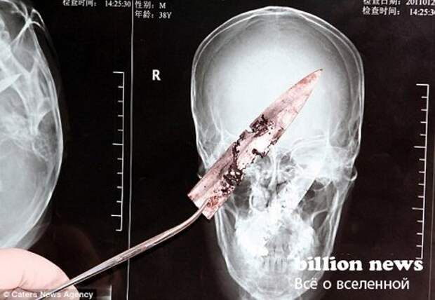 Самые интересные факты: человек прожил 4 года с ножом в черепе