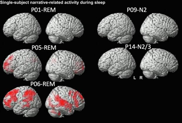 Мозг осмысленно обрабатывает звуки во время быстрого сна