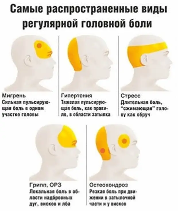 Что делать если болит затылок. Головная боль. Типы головной боли. Головная боль локализация. Причины головной боли.