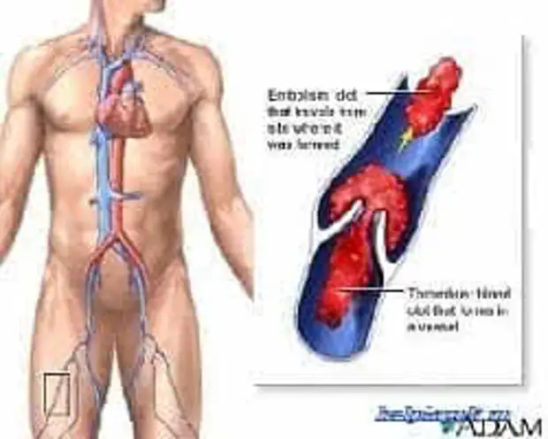 КАК ПРЕДОТВРАТИТЬ СКЛЕЙКУ СОСУДОВ И ВЯЗКОСТЬ КРОВИ