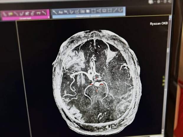 Врачи спасли от инсульта рязанца, выпивавшего по 7-8 банок энергетиков в день
