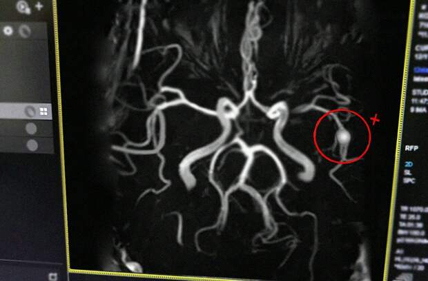 Рязанские врачи спасли мужчину от инсульта, за час растворив тромб
