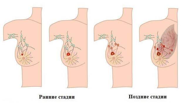 Рак молочной железы
