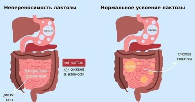 Можно ли победить непереносимость лактозы? Совет гастроэнтеролога