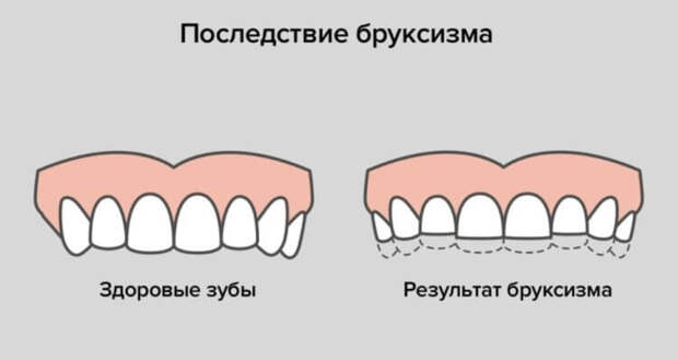 Симптомы бруксизма. При бруксизме часто стираются зубы, поэтому эту проблему важно решать как можно скорее. Фото.