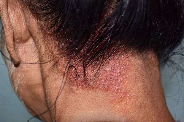 Genotek: у каждого седьмого россиянина повышен генетический риск стригущего лишая
