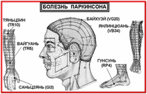 Болезнь Паркинсона