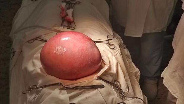 В Красноярском крае специалисты Федерального Сибирского научно-клинического центра ФМБА России провели операцию по удалению гигантской миомы матки весом пять килограммов. Размер опухоли сопоставим с доношенной беременностью. Чтобы спасти жизнь пациентке, врачам пришлось провести субтотальную гистерэктомия – удаление тела матки с сохранением шейки. Женщина поступила к специалистам с гигантской опухолью, которая занимала почти всю брюшную полость, давила на внутренние органы, узлы сдавливали крупные сосуды и мочеточники, угрожая почечной недостаточностью.