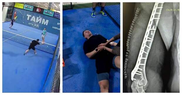 Парень получил сложный перелом руки, играя в падел