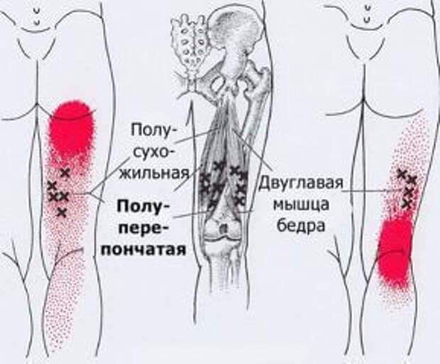 Карта триггерных точек на ногах