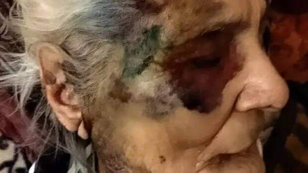 Напомним, дочь 90-летней жительницы рассказала, что медперсонал ГБУЗ СК «ГКБ № 2» истязал ее мать. На теле у пожилой женщины родственники обнаружили многочисленные синяки и гематомы. Кроме того, со слов близких, старушку привязывали к кровати и не давали есть и пить. Инцидент произошел в марте этого года. Тогда в больнице заверили, что огромный синяк на пол-лица появился из-за того, что женщина потянулась за водой и ударилась о тумбочку.