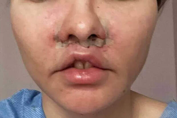 На Урале пациентка отсудила у клиники 1,5 млн рублей за неудачную пластику губ