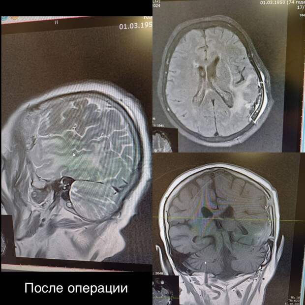 В Мелитопольскую областную была доставлена пациентка, которую беспокоили жалобы на головные боли, головокружения, снижение памяти и дезориентацию. Проведено МРТ обследование, установлено наличие объемного образования головного мозга затылочной доли слева. Врачами принято решение неотложно провести хирургическое вмешательство. Опухоль максимально удалили. По словам оперирующего нейрохирурга Михаила Еремеева, сложность операции заключалась в ее радикальности: