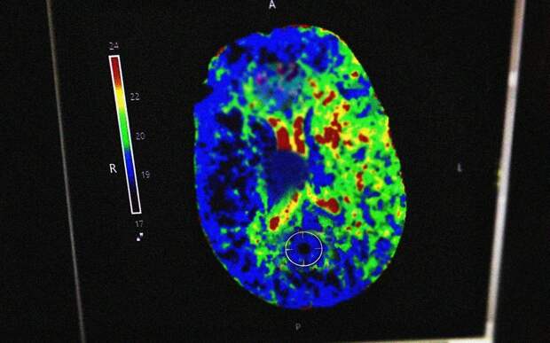 В Рязанской ОКБ помогли пациентке с инсультом