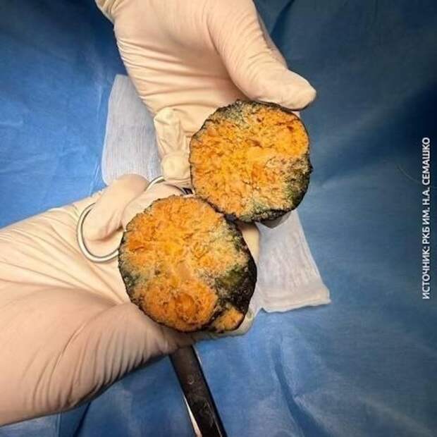 Хурма едва не убила жителя Улан-Удэ — ему потребовалась срочная операция.