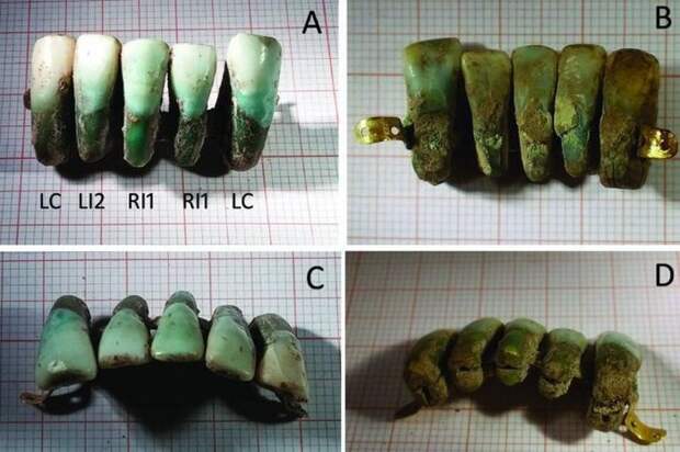 Самые древние зубные протезы.