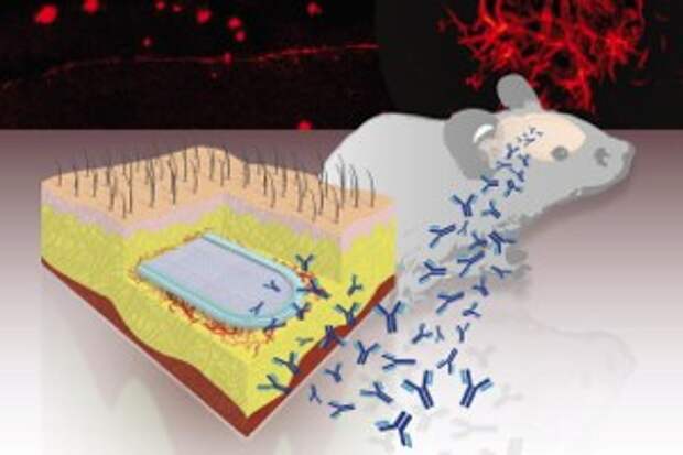 implant-to-prevent-alzheimers-disease-2