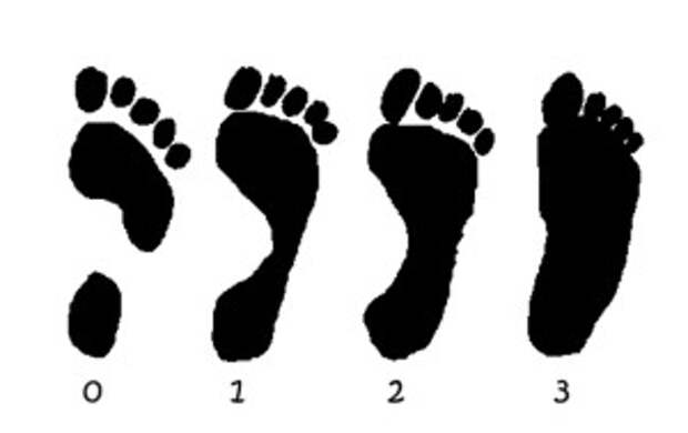 Flatfeet