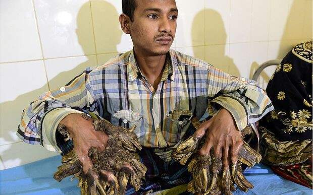 Человек-дерево готовится к операции по удалению пяти килограмм бородавок Человек-дерево, бангладеш, операция