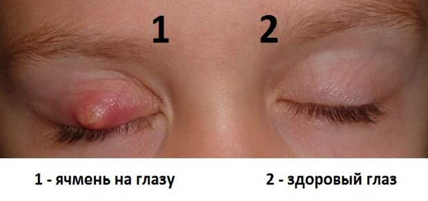 pechen-yachmen-na-glazu-u-rebenka