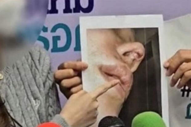 В Таиланде врачи изуродовали блогершу, потратившую на ринопластику 400 тысяч бат