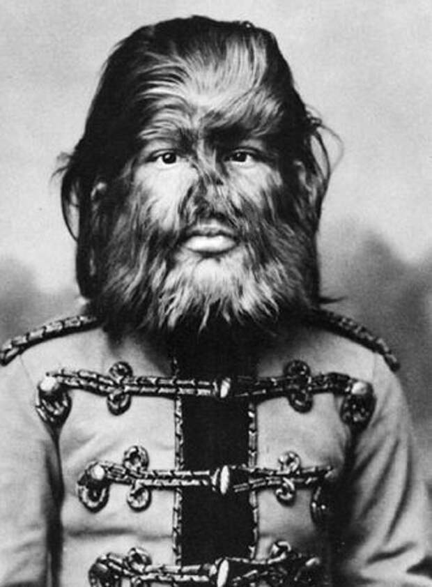 Фёдор Евтищев (1868-1904) — «мальчик с собачьей мордой», знаменитый актёр цирка Барнума.