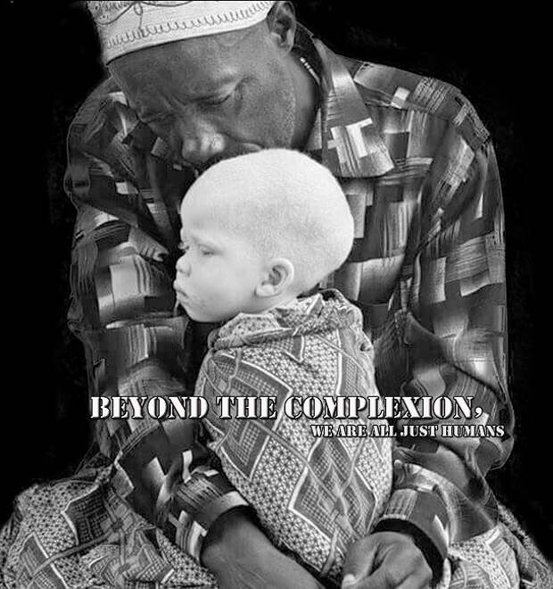 beyond-the-complexion-albinism-poster-610x650
