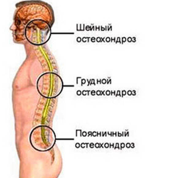 Признаки грудного остеохондроза симптомы