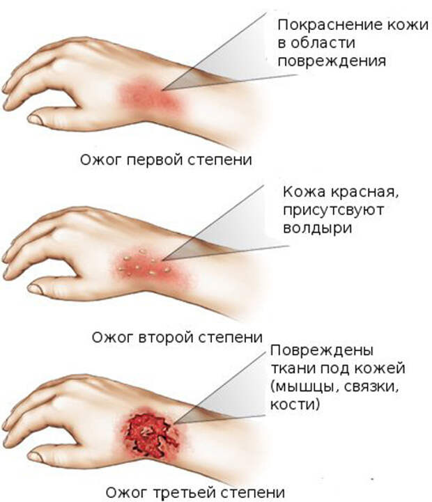11. Ожог 11. Ожог Лайфхак, коты, медицина, помощь, факты