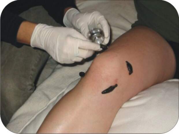 leech-suck-therapy-570x428
