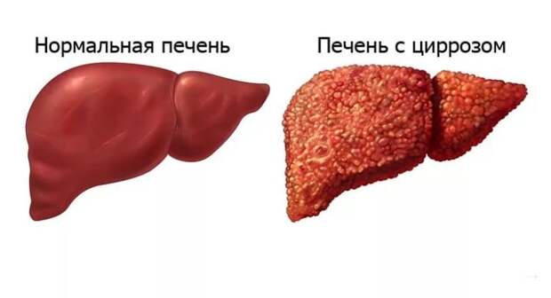 Цирроз печени: характеристика, причины и лечение