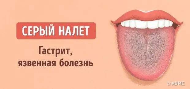 Расскажи язык. Заболевания по цвету языка.