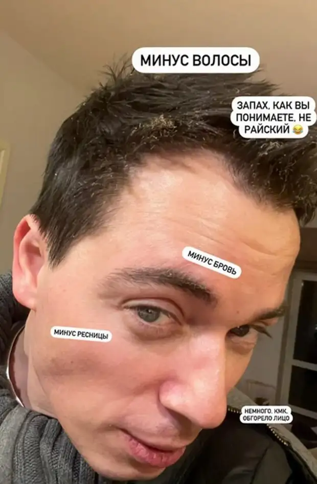 Обгоревшему сыну Газманова дают меньше месяца