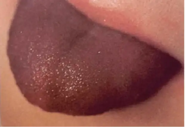 Что расскажет язык о вашем здоровье