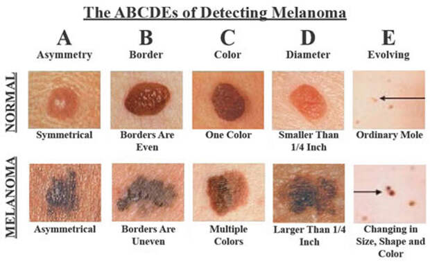 3. Миф: Большинство случаев рака кожи не опасны. безопасность, загар, лето, солнце