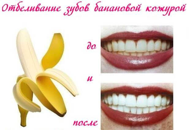 отбеливание банановой кожурой отзывы зубов