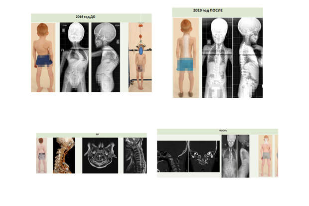 В Перми 13-летний ребенок едва не остался инвалидом из-за шутки одноклассника