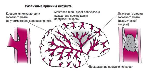 причины инсульта