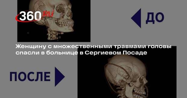 Женщину с множественными травмами головы спасли в больнице в Сергиевом Посаде