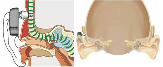 Звук костей. Слуховой аппарат костной проводимости ponto. Слуховой аппарат костной проводимости Baha. Слуховые аппараты костного звукопроведения. Имплантируемый слуховой аппарат костной проводимости.