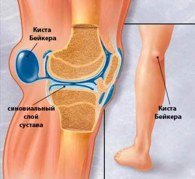 Киста Бейкера – что это, как обнаружить и лечить?